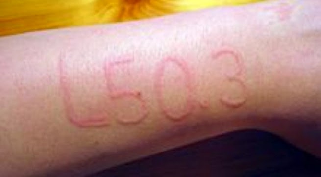 Chứng da vẽ nổi - Hình ảnh minh họa